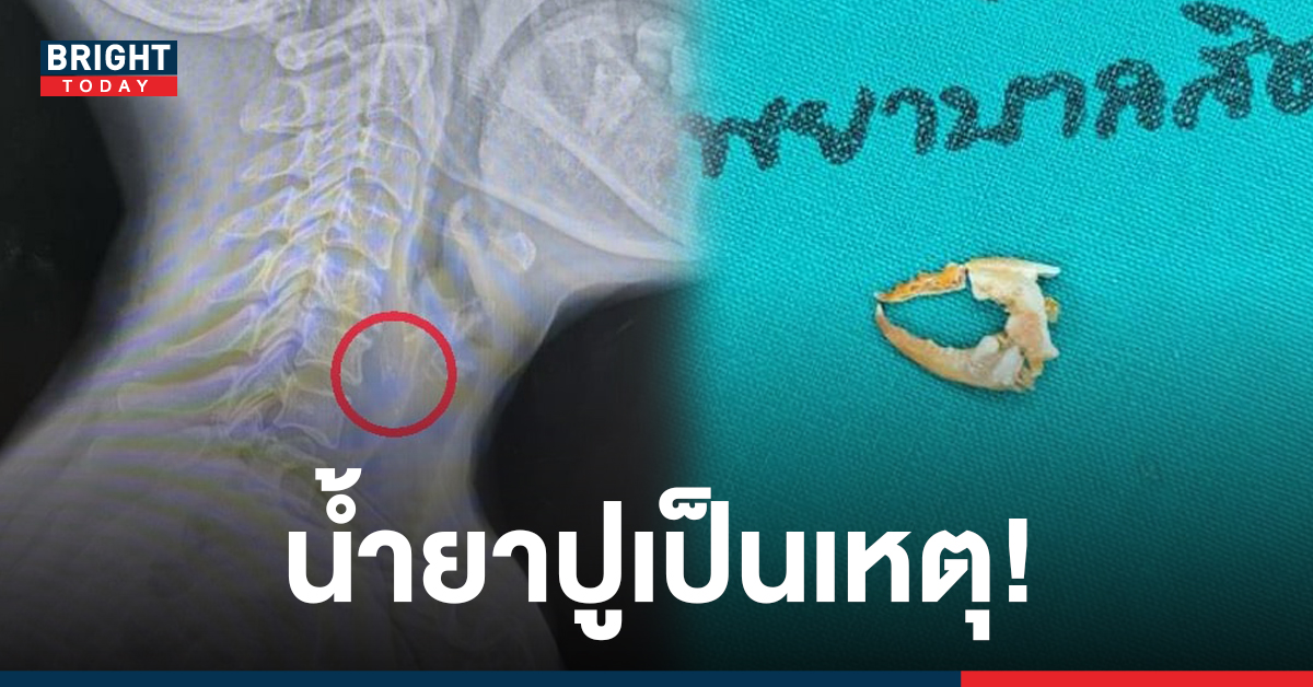 ของกินเป็นเหตุ! ตาวัย 70 ปี ซดขนมจีนน้ำยาปูอย่างเอร็ดอร่อย สุดท้ายเจอก้ามปูติดคอ!