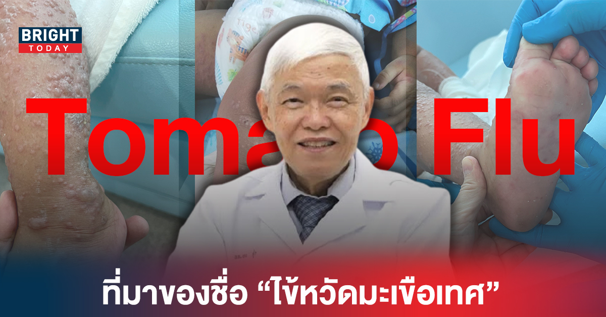 ไขข้อสงสัย! ทำไมถึงตั้งชื่อว่า “ไข้หวัดมะเขือเทศ” ชี้ ไม่รุนแรง/หายได้เอง