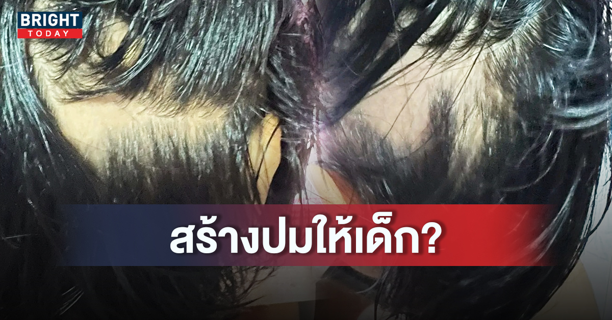 ลูกสาว 9 ขวบ ผมร่วงหมดหัว พ่อแม่สงสัยเพราะฉีควัคซีนป้องกันโควิด 19 ?