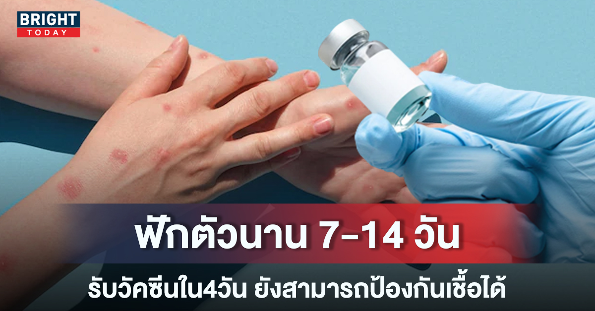 หมอยง ชี้ ผู้ที่สัมผัสเชื้อ ฝีดาษลิง ภายใน4วัน ฉีดวัคซีนยังสามารถป้องกันได้