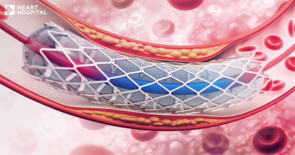 Acute myocardial ischemia