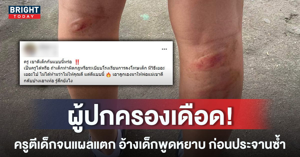 หน้าปกใหม่-เด็กโดนครูตีแผลแตก