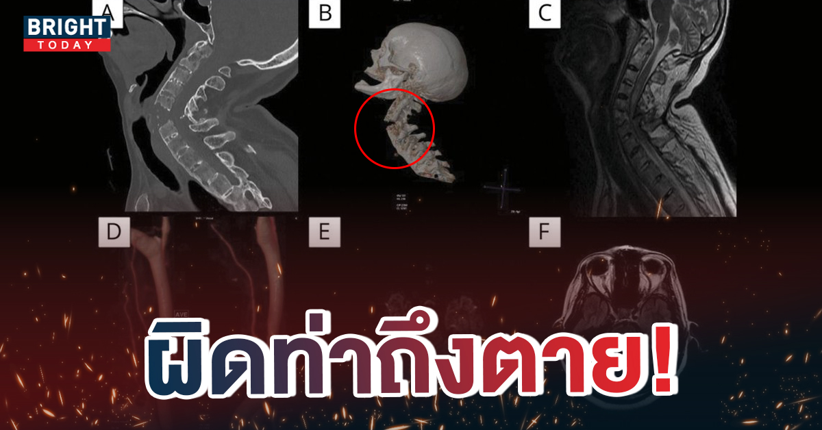 หน้าปกใหม่-จัดกระดูฏผิดท่าถึงตาย