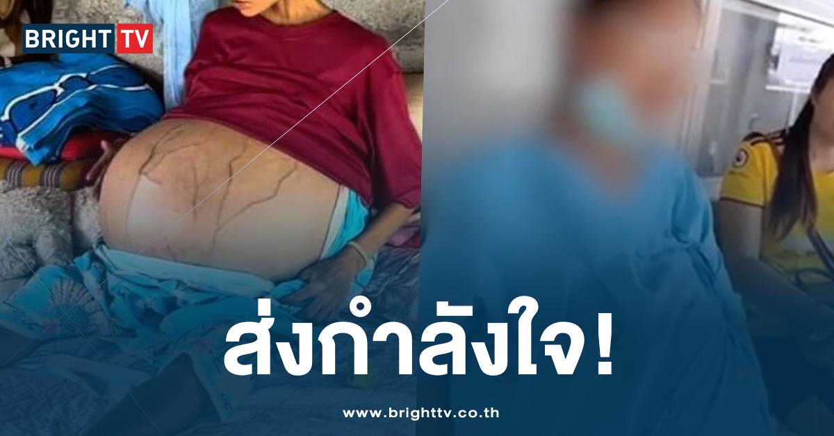 สาวท้องโต ได้ผ่าตัดแล้ว หลังทรมาณกับเนื้องอกในมดลูกมานานกว่า 10 ปี