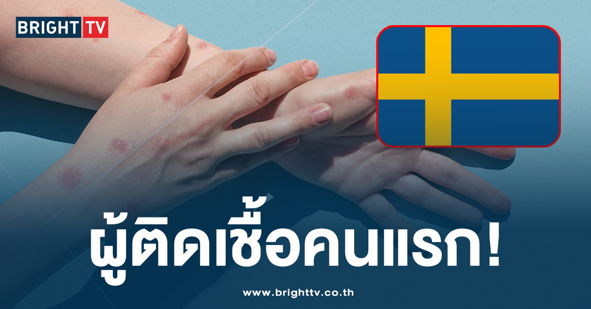 ‘สวีเดน’ ติดเชื้อฝีดาษลิง สายพันธุ์ เคลด วัน รายแรก นอกแอฟริกา