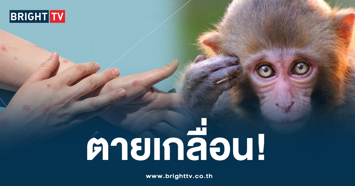 WHO ประกาศยกระดับ ‘ฝีดาษลิง’ เป็นภาวะฉุกเฉิน หลังพบสายพันธุ์ใหม่!