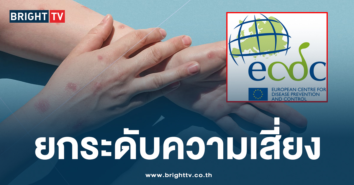 EU-ECDC ยกระดับเชื้อ ‘ฝีดาษลิง’ หลังพบผู้ป่วยชาว สวีเดน ป่วยรายแรก