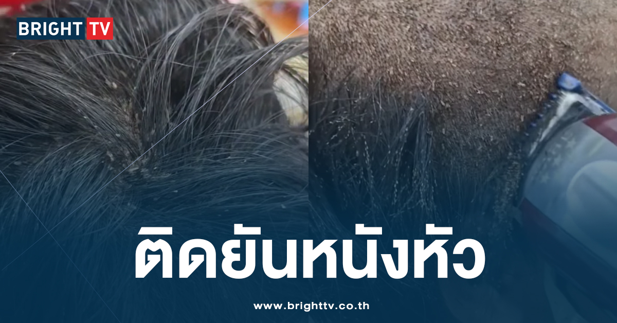 เหาติดยันหนังหัว